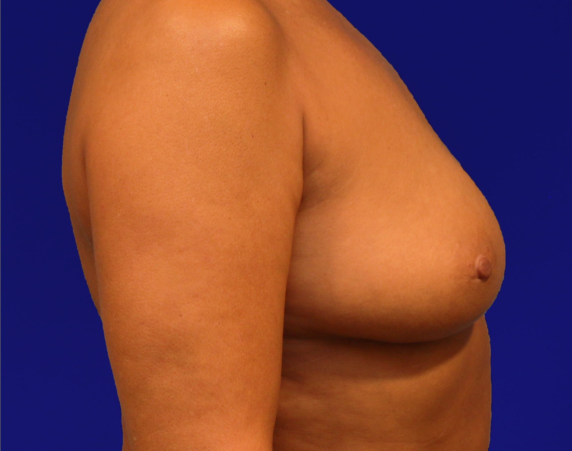 Breast Augmentation Before & After Gallery - Patient 160197 - Image 7