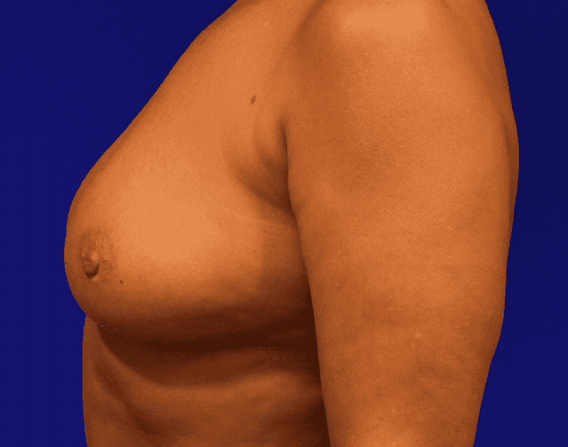 Breast Augmentation Before & After Gallery - Patient 160197 - Image 9