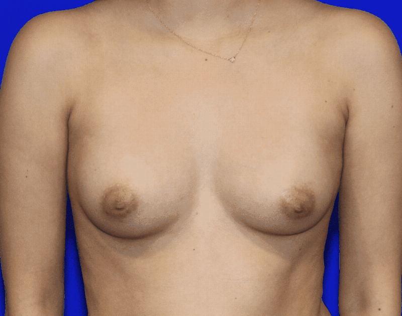 Breast Augmentation Before & After Gallery - Patient 440735 - Image 1