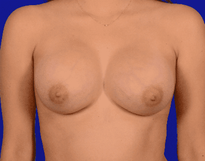 Breast Augmentation Before & After Gallery - Patient 440735 - Image 2