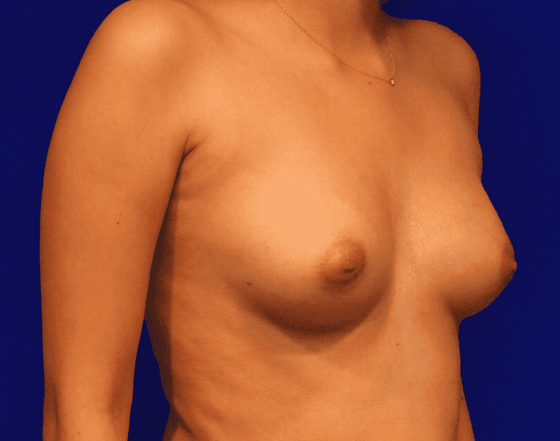 Breast Augmentation Before & After Gallery - Patient 440735 - Image 5