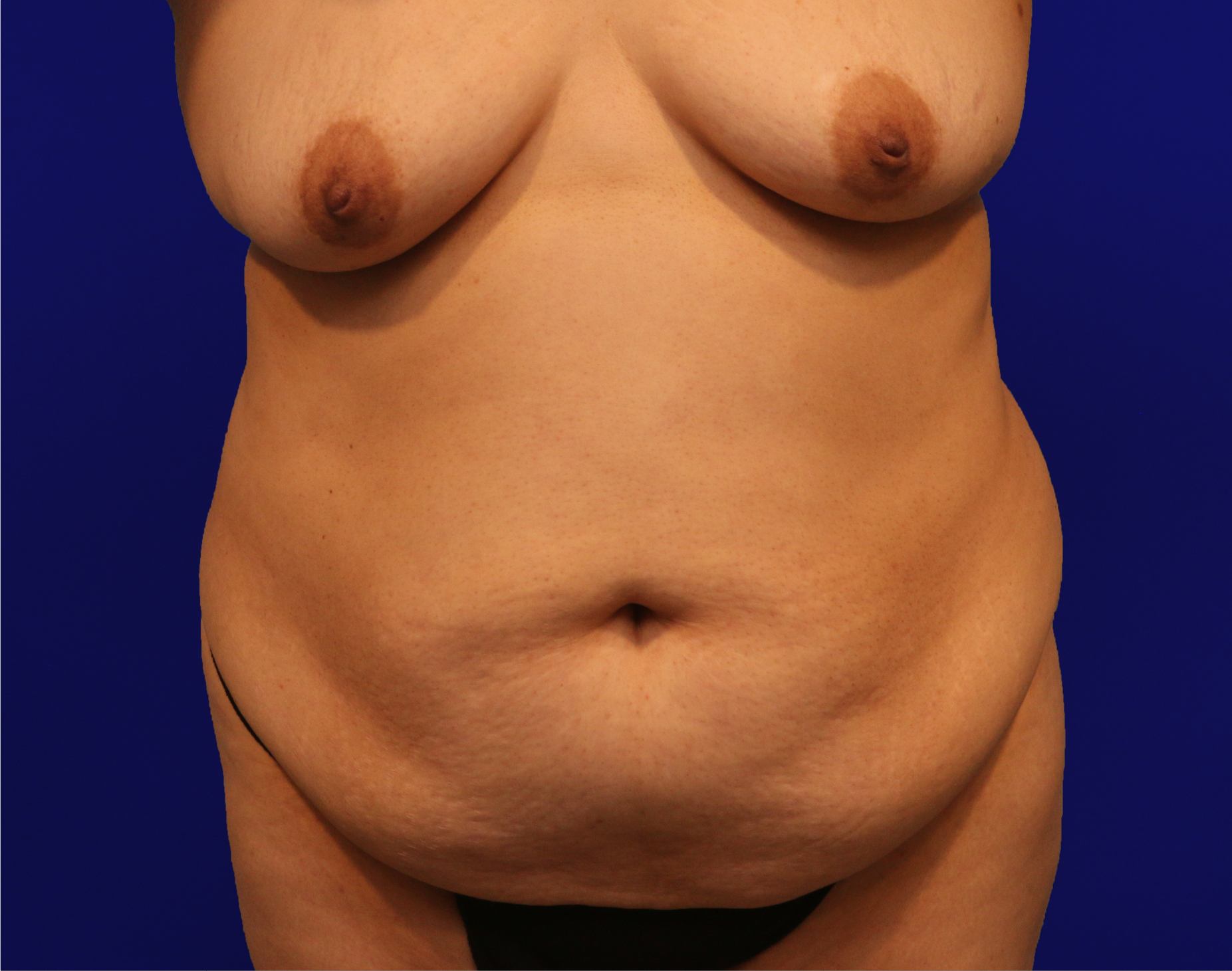 Tummy Tuck Before & After Gallery - Patient 284970 - Image 1