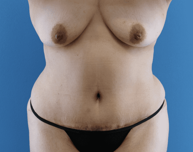 Tummy Tuck Before & After Gallery - Patient 284970 - Image 2