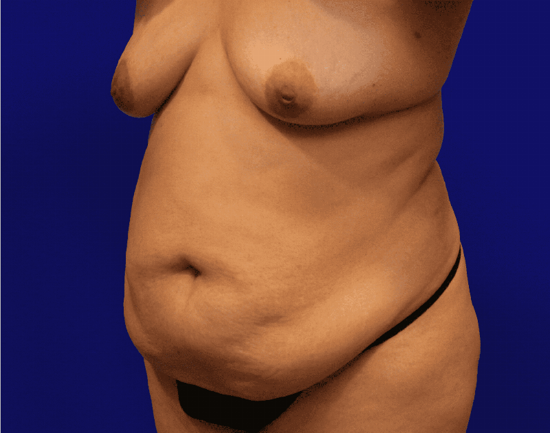 Tummy Tuck Before & After Gallery - Patient 284970 - Image 3