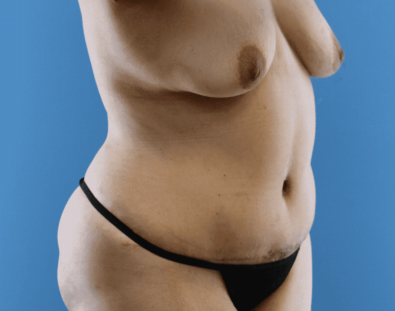 Tummy Tuck Before & After Gallery - Patient 284970 - Image 6