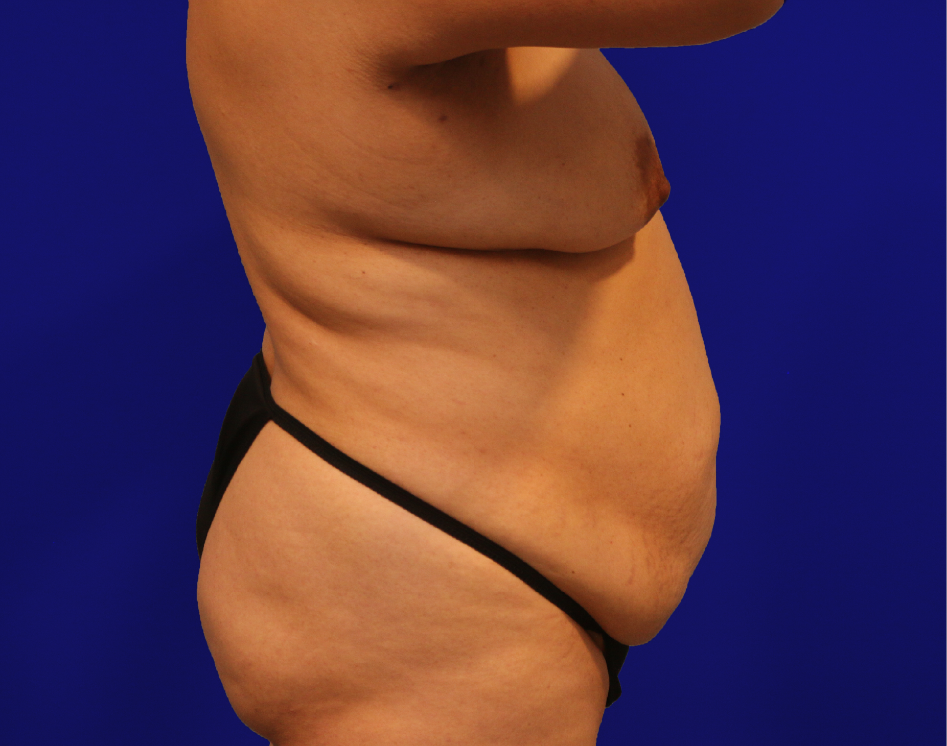 Tummy Tuck Before & After Gallery - Patient 284970 - Image 9