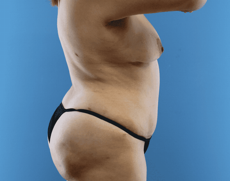 Tummy Tuck Before & After Gallery - Patient 284970 - Image 10