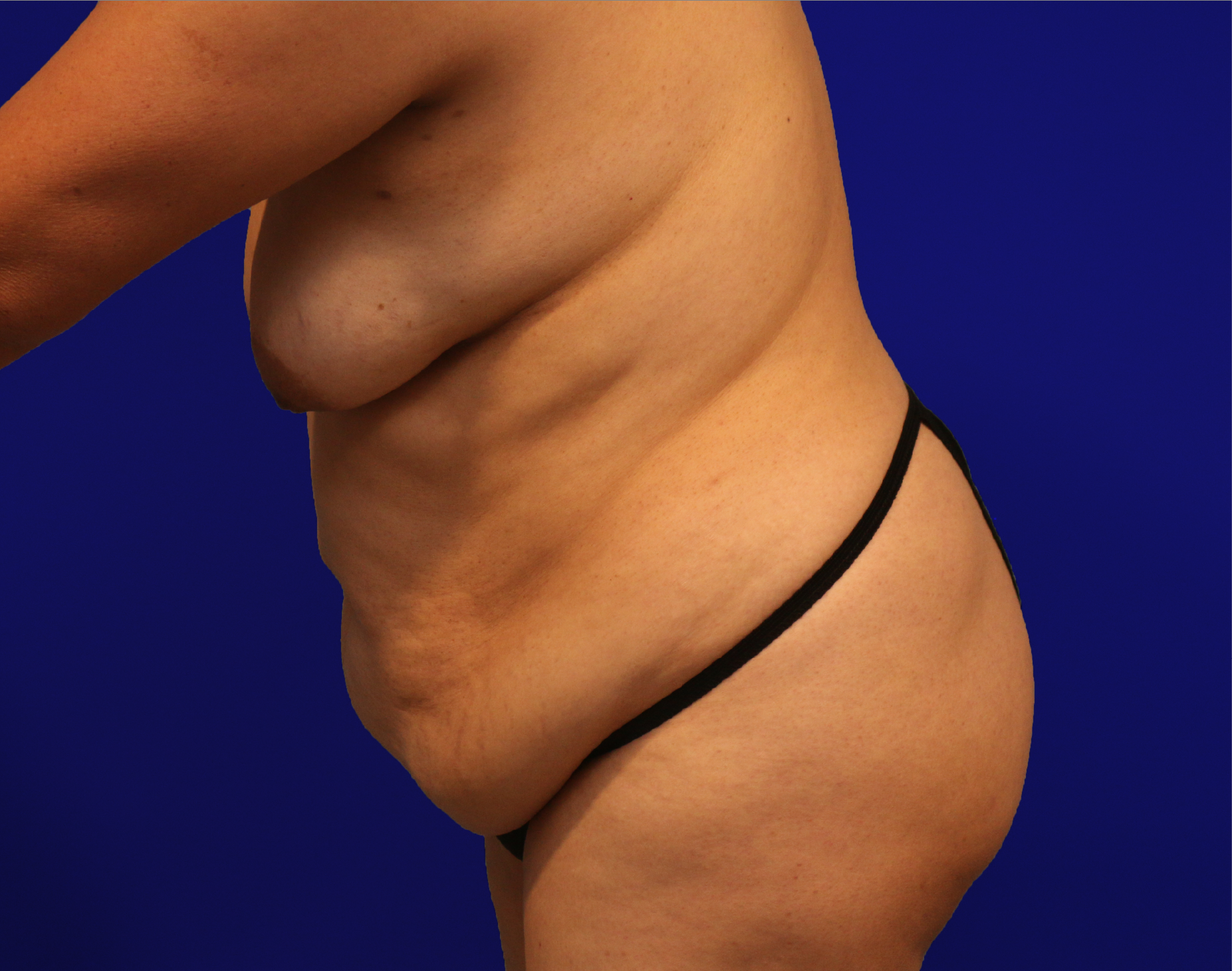 Tummy Tuck Before & After Gallery - Patient 284970 - Image 11