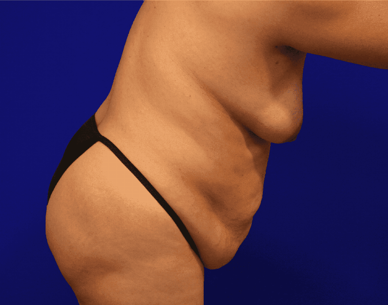 Tummy Tuck Before & After Gallery - Patient 284970 - Image 13