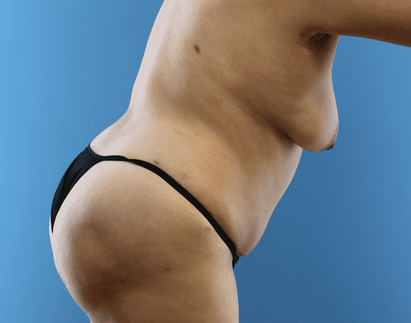 Tummy Tuck Before & After Gallery - Patient 284970 - Image 14