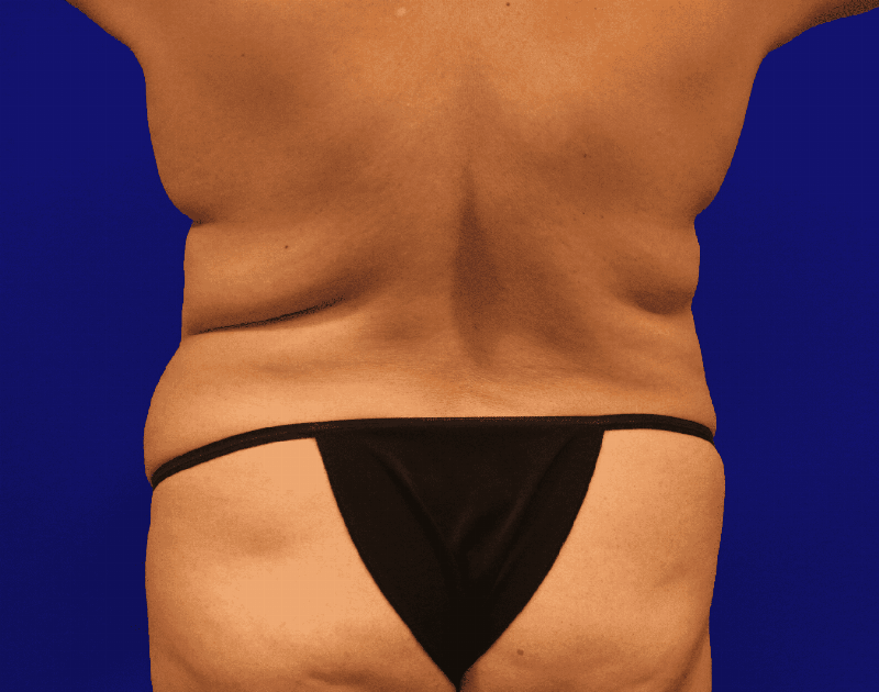 Tummy Tuck Before & After Gallery - Patient 284970 - Image 15