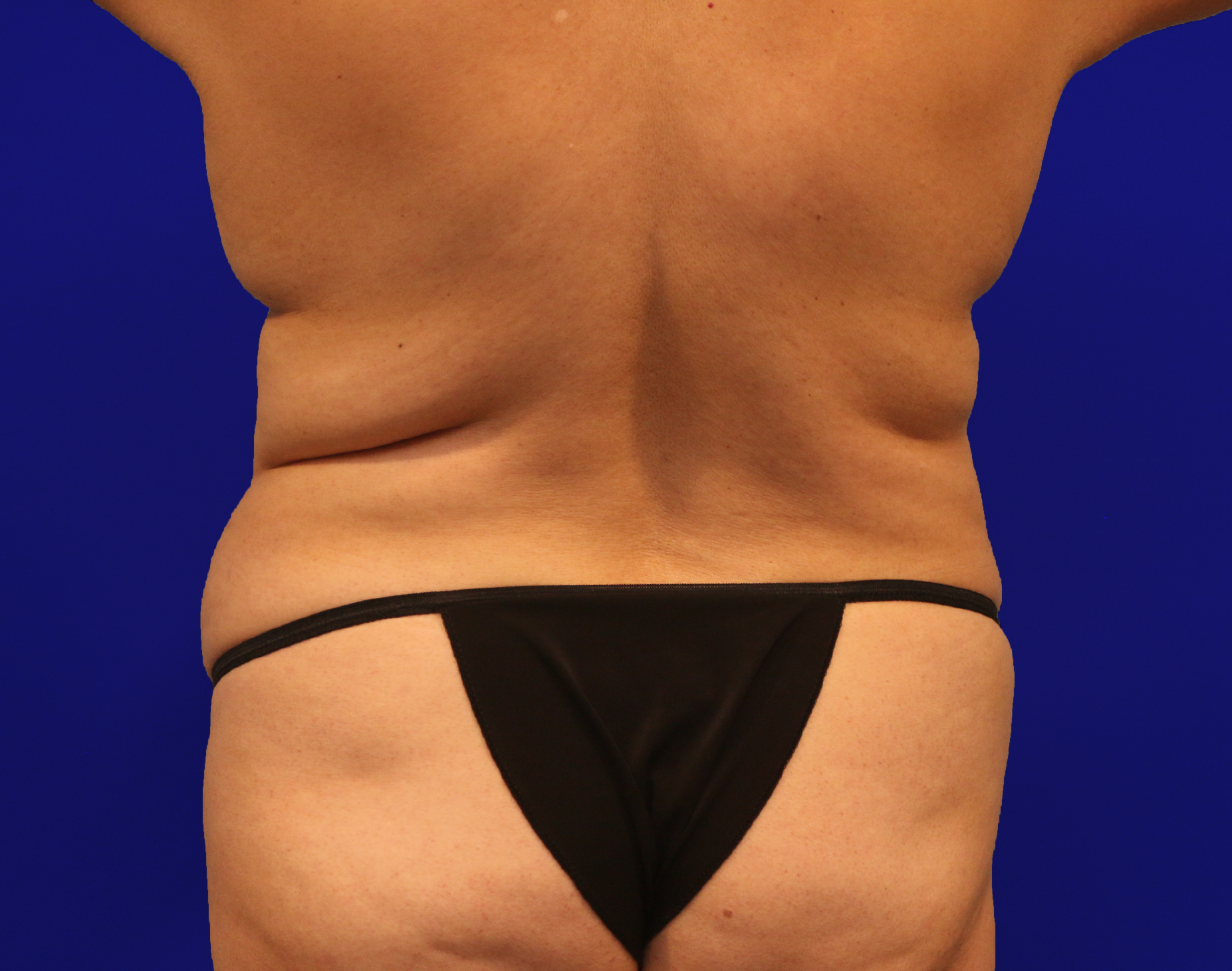 Tummy Tuck Before & After Gallery - Patient 284970 - Image 15