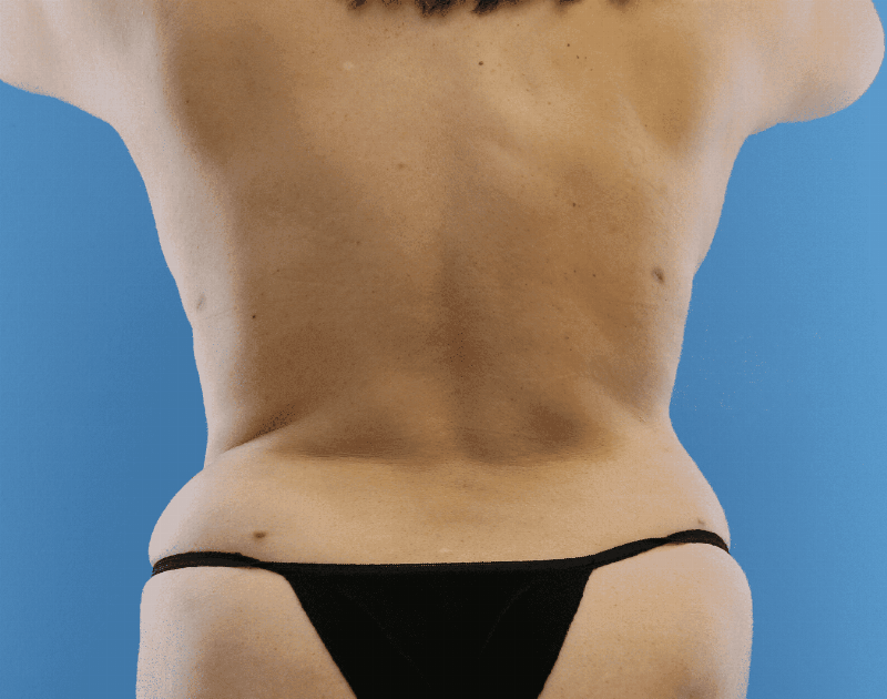 Tummy Tuck Before & After Gallery - Patient 284970 - Image 16