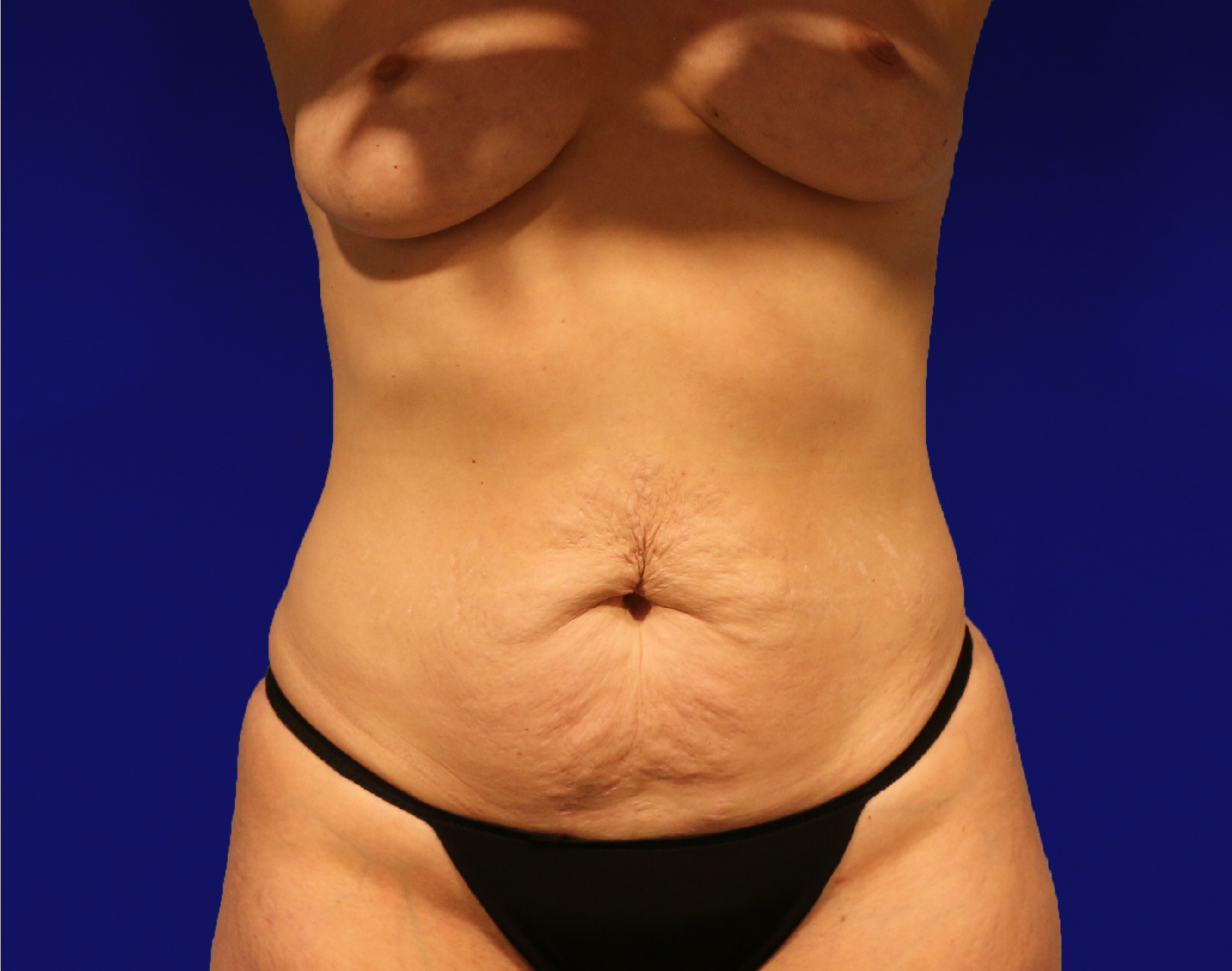 Tummy Tuck Before & After Gallery - Patient 230347 - Image 1