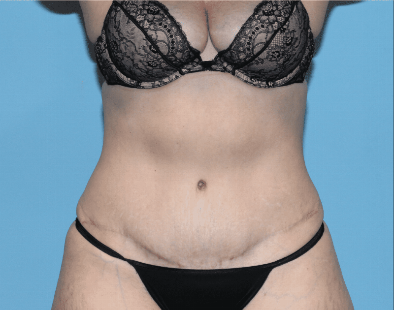 Tummy Tuck Before & After Gallery - Patient 230347 - Image 2