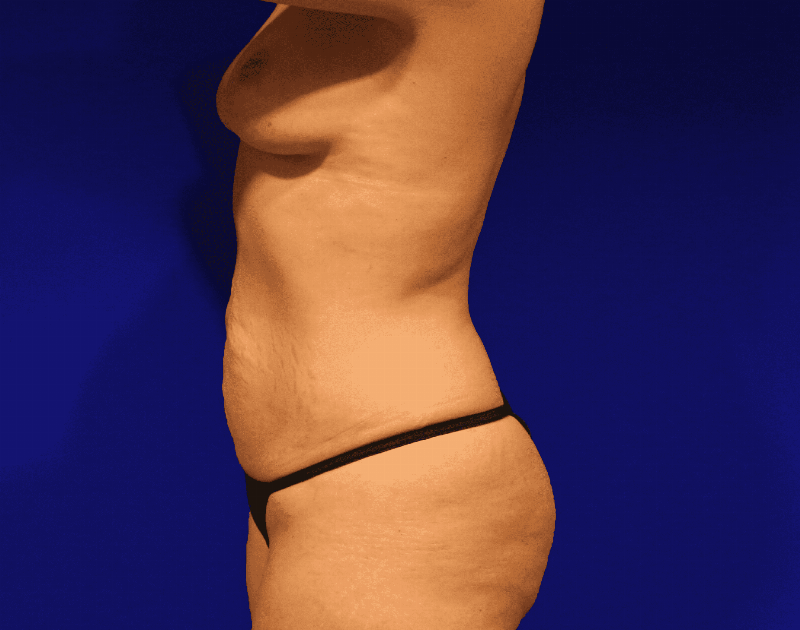 Tummy Tuck Before & After Gallery - Patient 230347 - Image 11