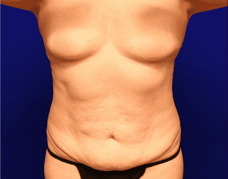 Tummy Tuck Before & After Gallery - Patient 237595 - Image 1