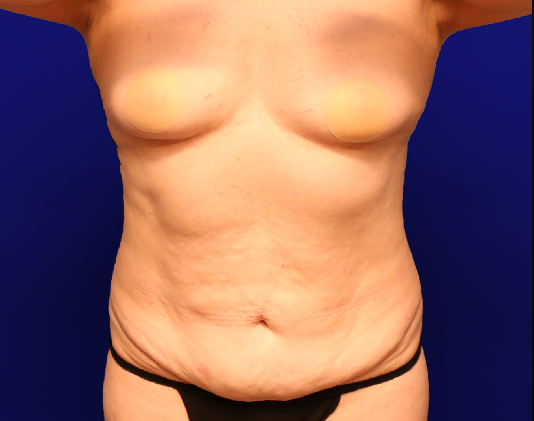 Tummy Tuck Before & After Gallery - Patient 237595 - Image 1