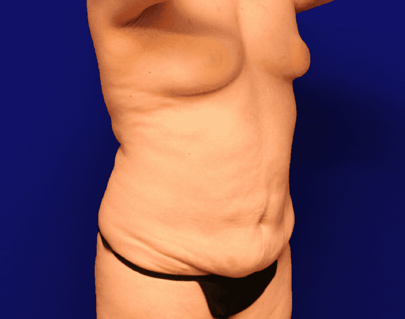 Tummy Tuck Before & After Gallery - Patient 237595 - Image 5