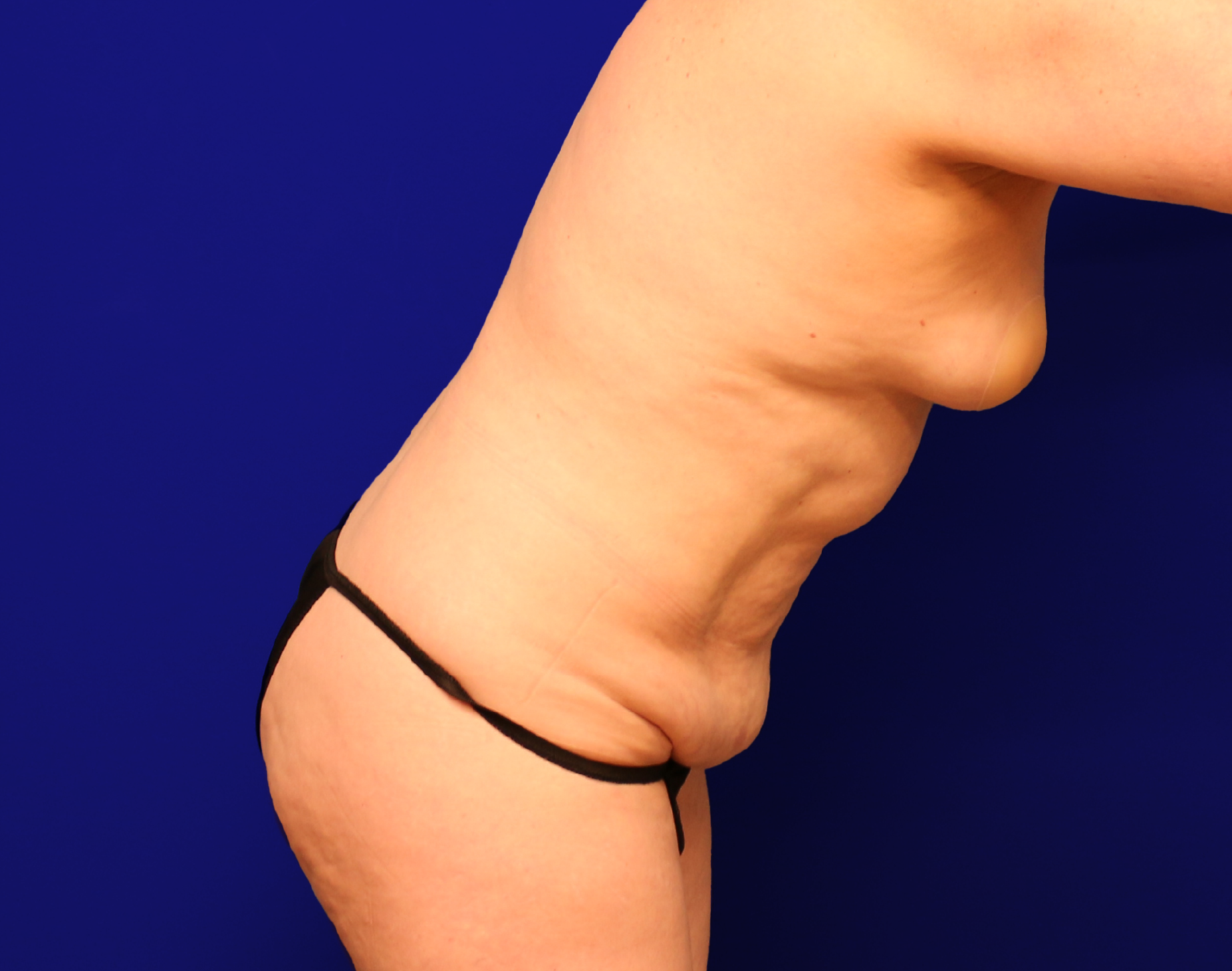 Tummy Tuck Before & After Gallery - Patient 237595 - Image 9