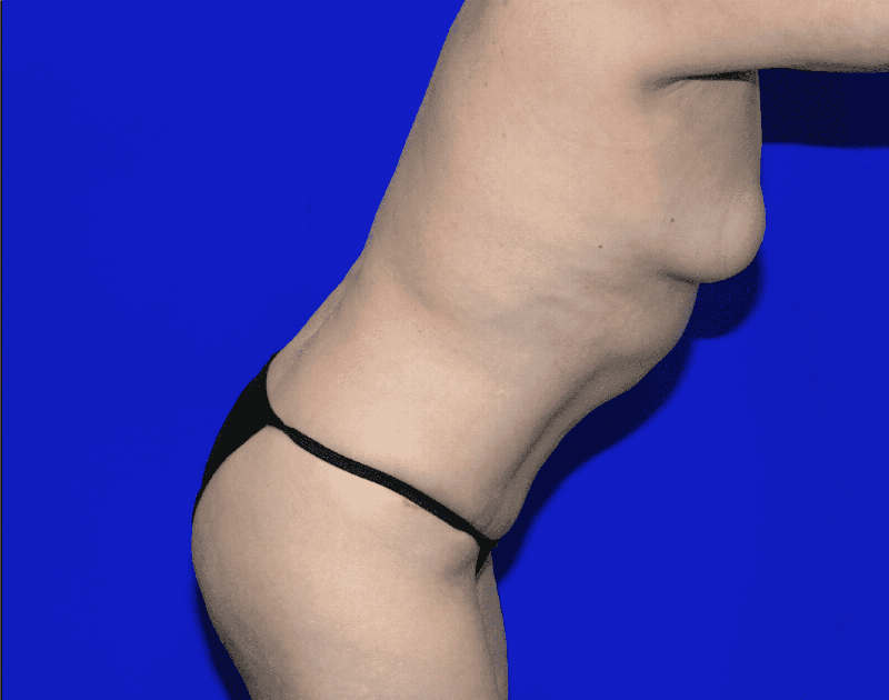 Tummy Tuck Before & After Gallery - Patient 237595 - Image 10