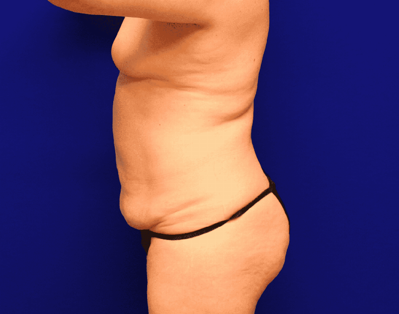 Tummy Tuck Before & After Gallery - Patient 237595 - Image 11