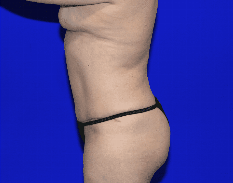 Tummy Tuck Before & After Gallery - Patient 237595 - Image 12