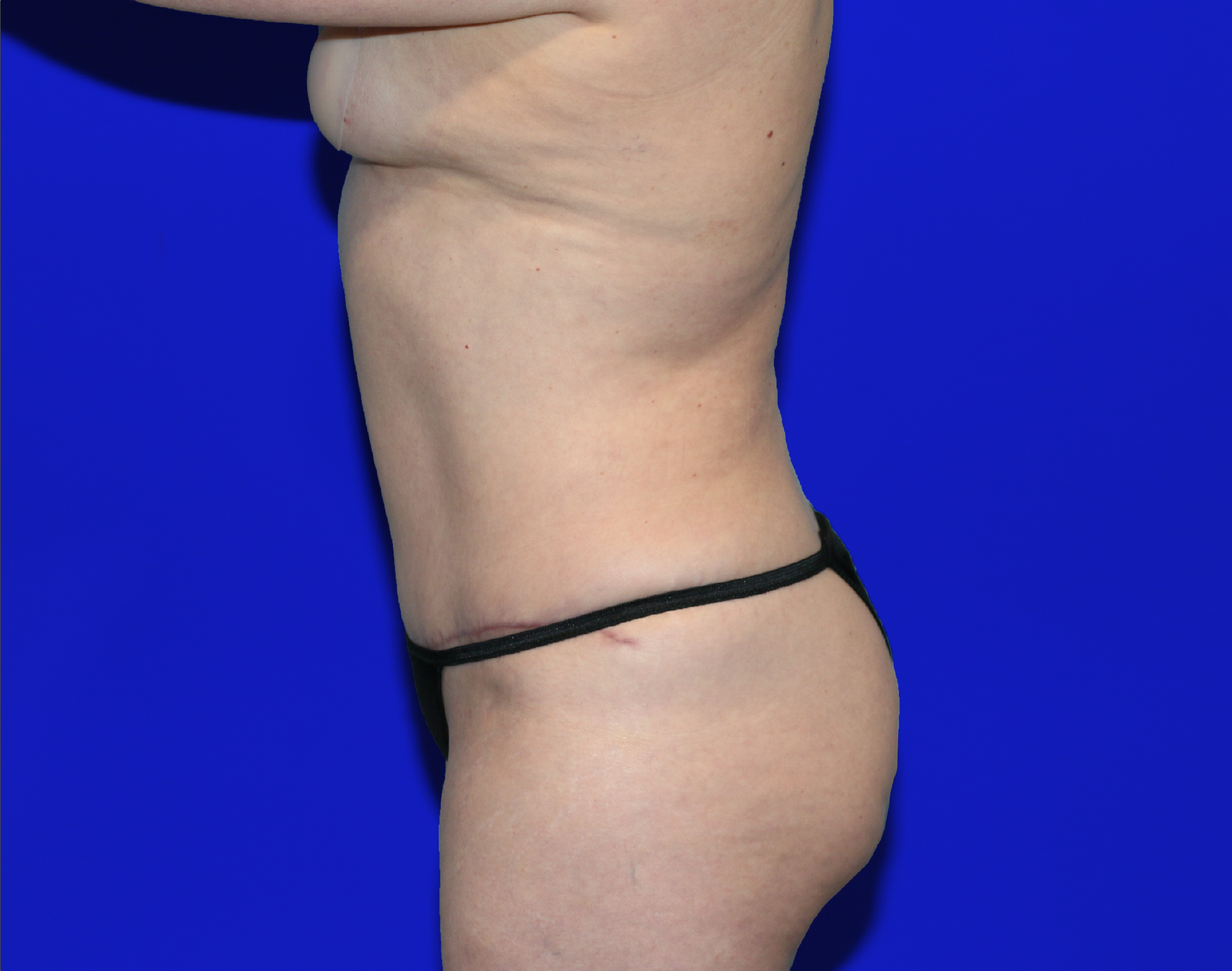 Tummy Tuck Before & After Gallery - Patient 237595 - Image 12