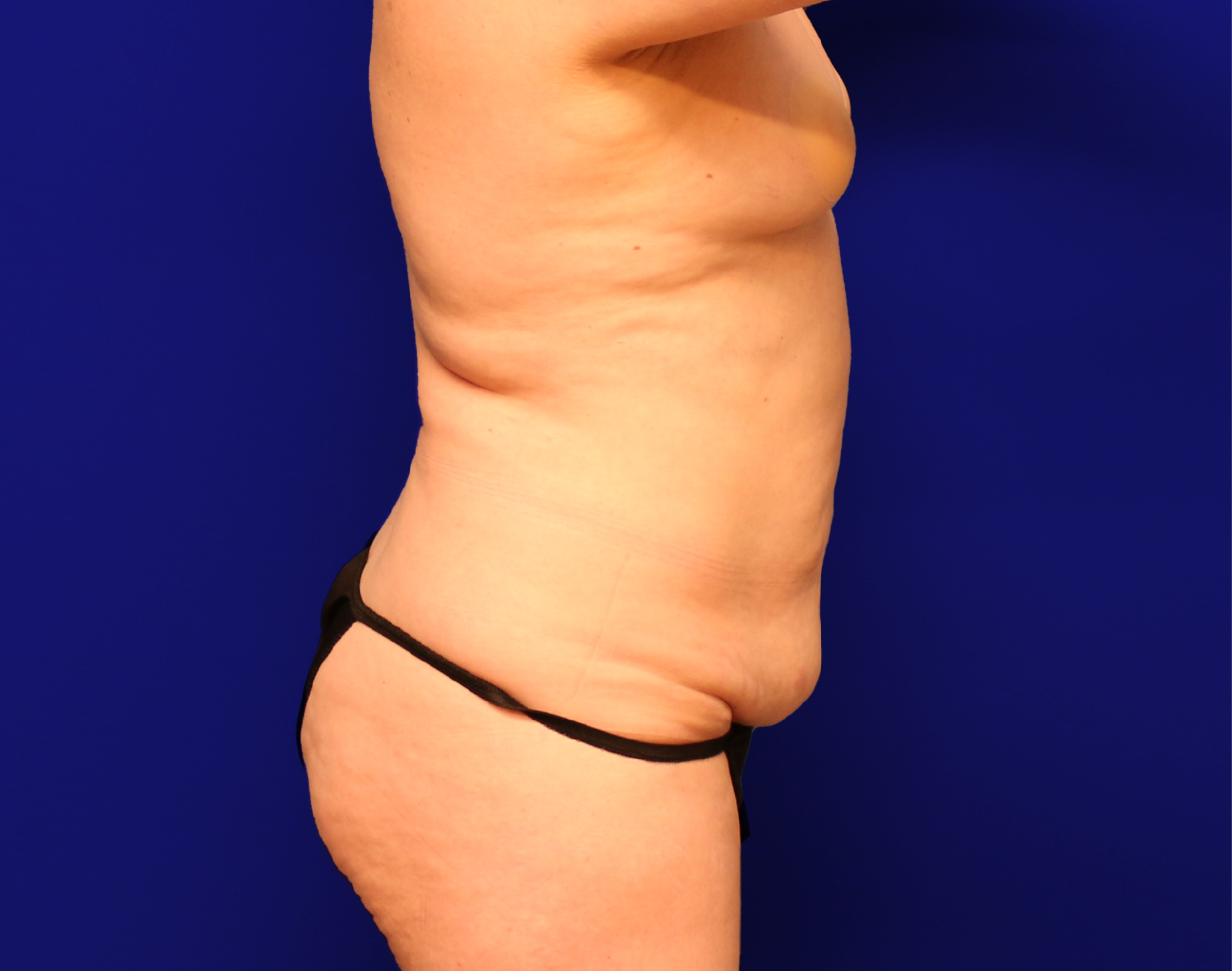 Tummy Tuck Before & After Gallery - Patient 237595 - Image 13