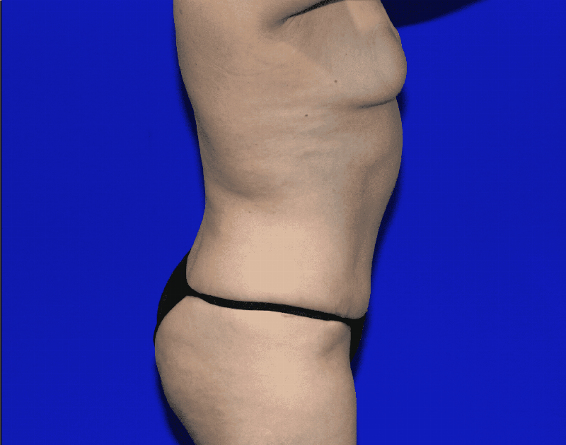 Tummy Tuck Before & After Gallery - Patient 237595 - Image 14