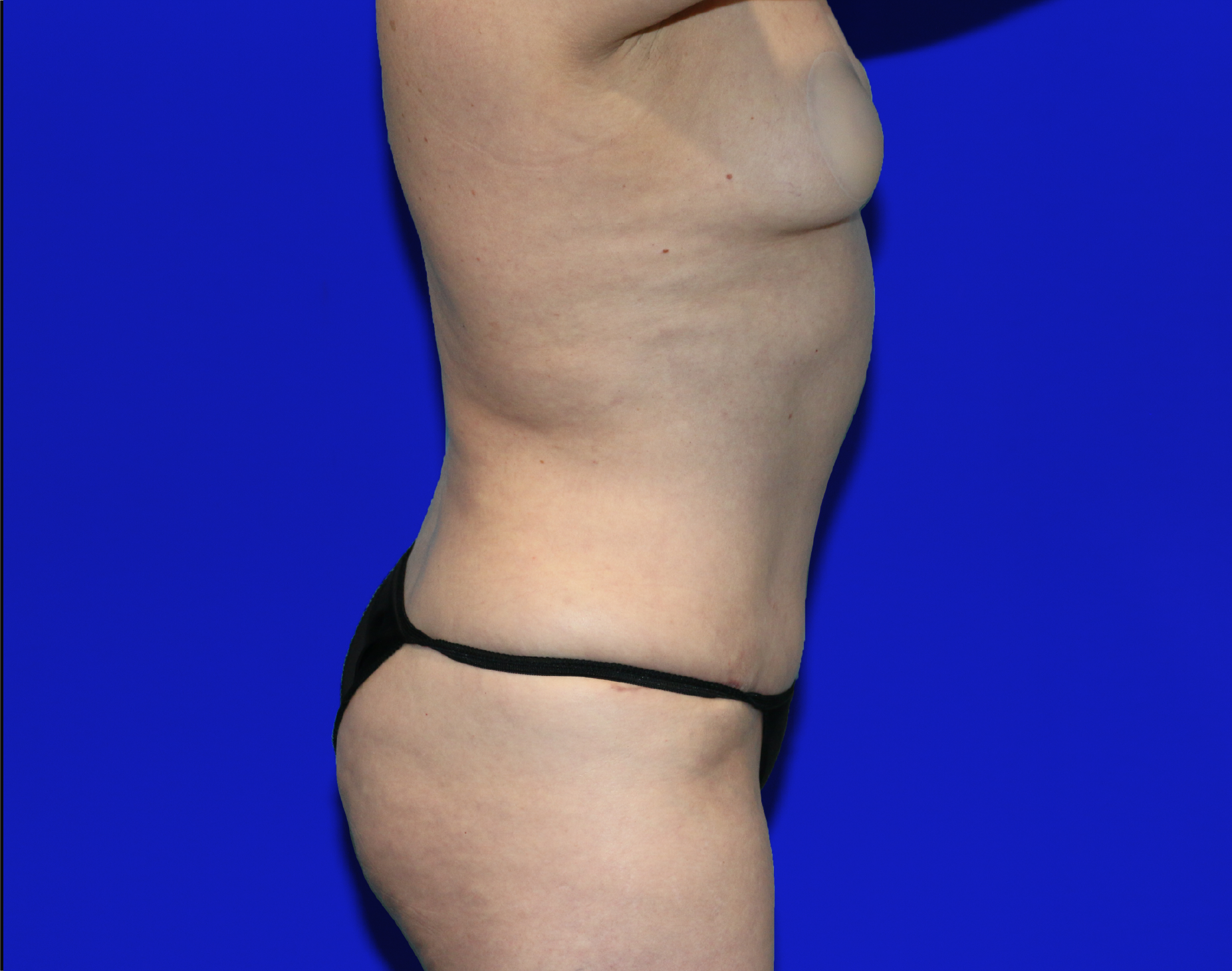 Tummy Tuck Before & After Gallery - Patient 237595 - Image 14