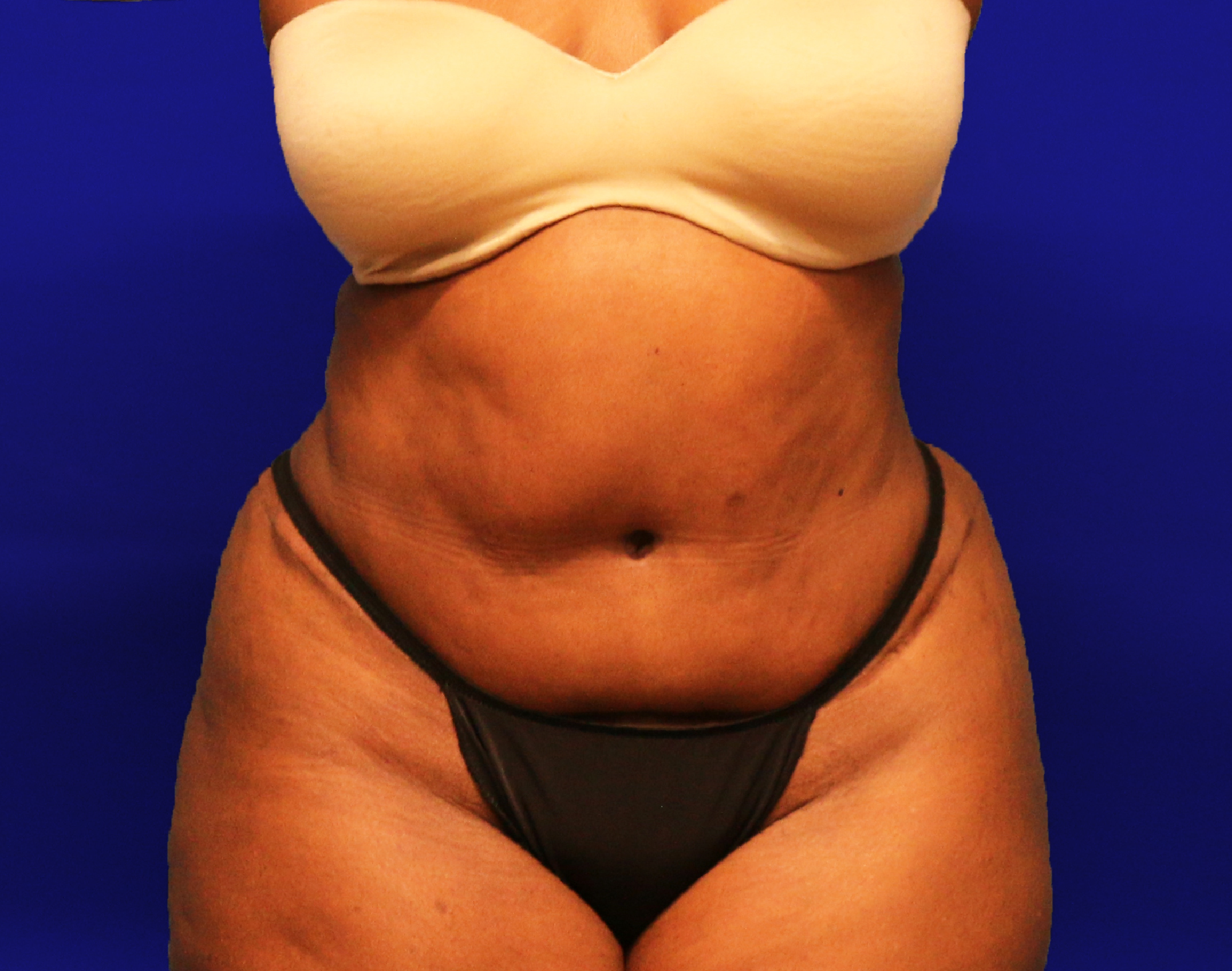 Tummy Tuck Before & After Gallery - Patient 546200 - Image 2