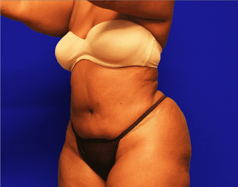 Tummy Tuck Before & After Gallery - Patient 546200 - Image 4