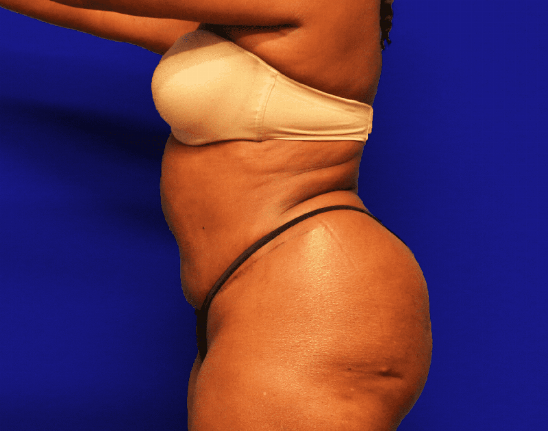 Tummy Tuck Before & After Gallery - Patient 546200 - Image 6