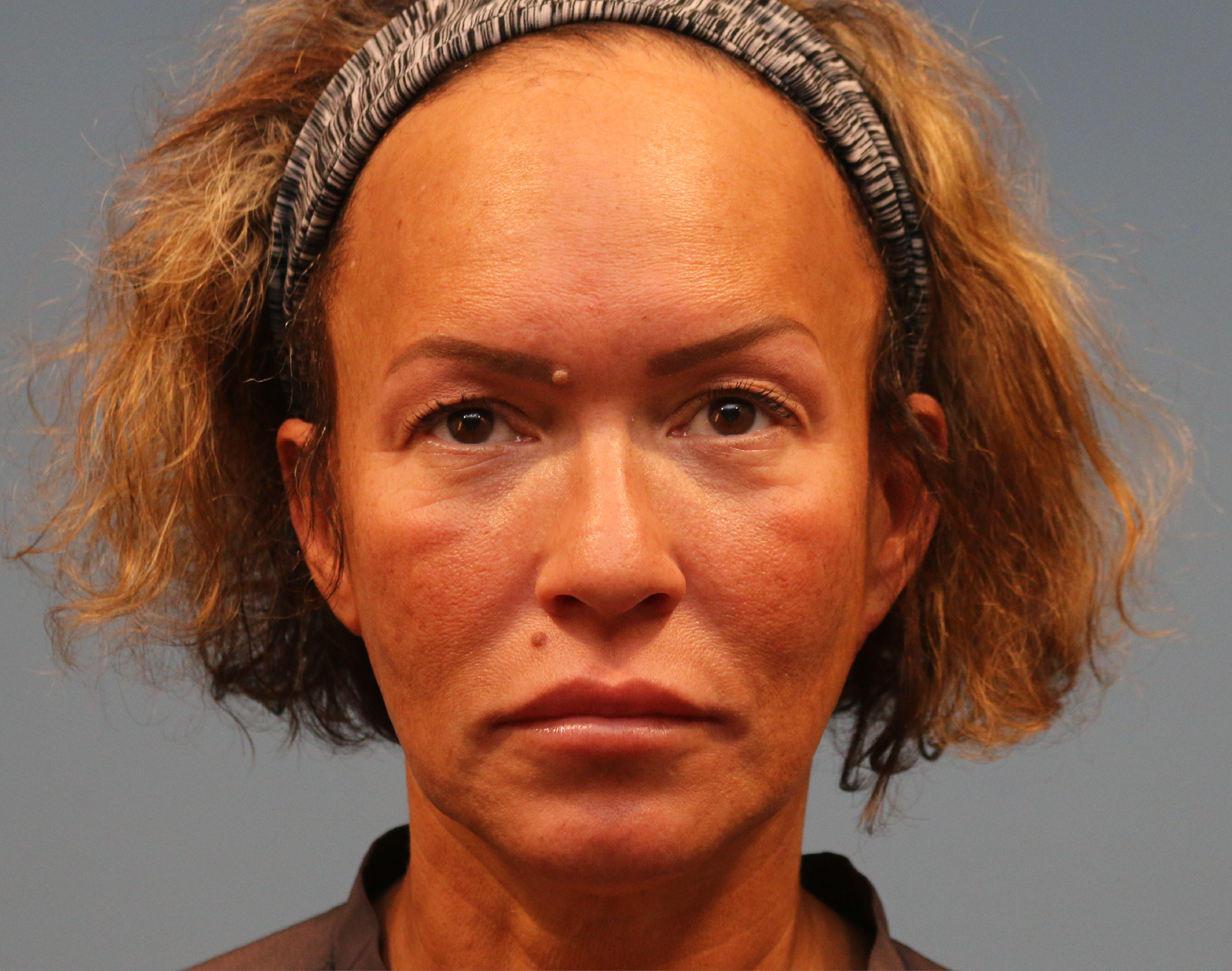 Blepharoplasty Before & After Gallery - Patient 229293 - Image 1