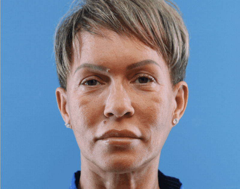 Blepharoplasty Before & After Gallery - Patient 229293 - Image 2