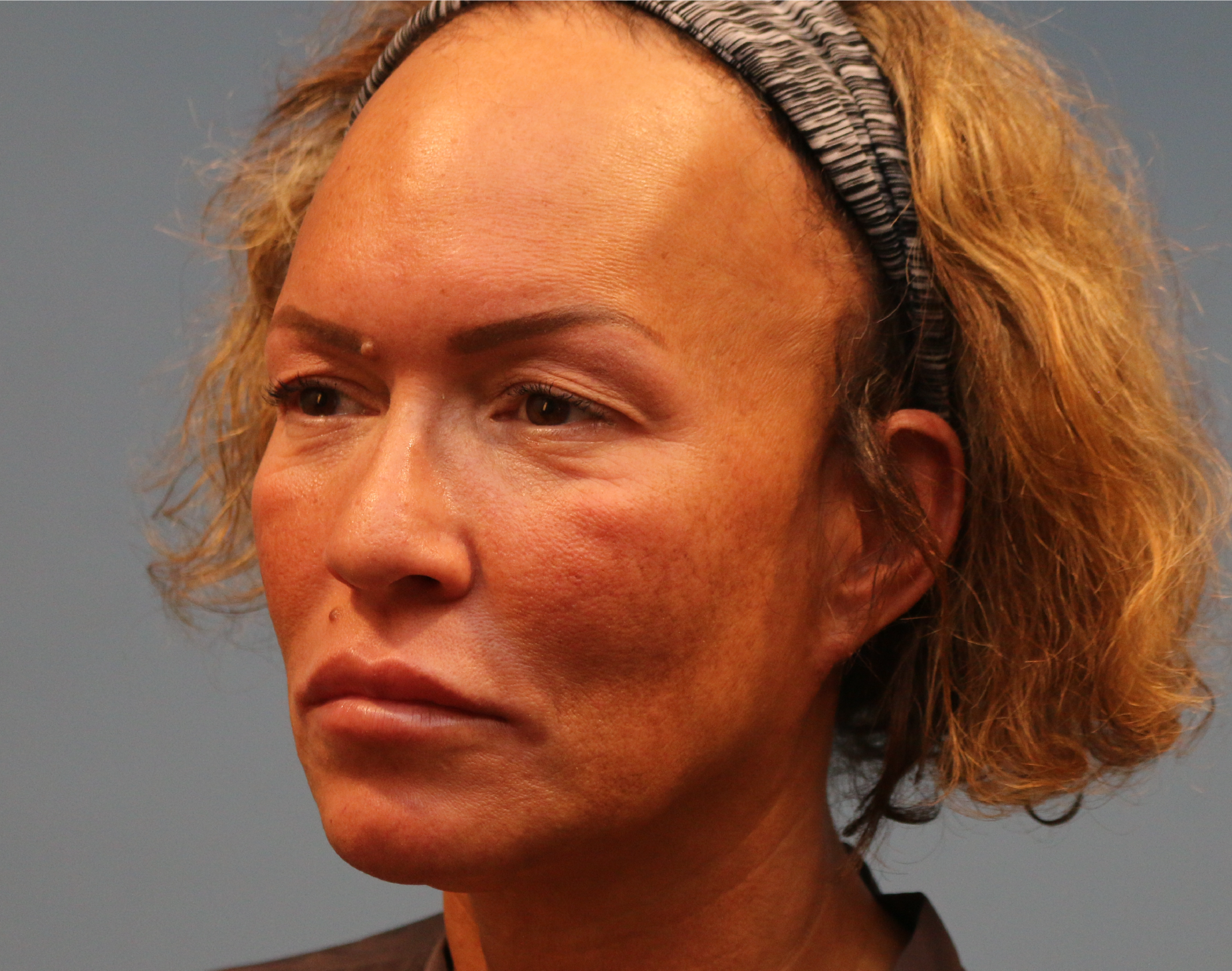 Blepharoplasty Before & After Gallery - Patient 229293 - Image 3