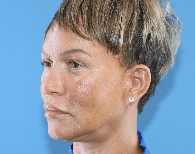 Blepharoplasty Before & After Gallery - Patient 229293 - Image 4