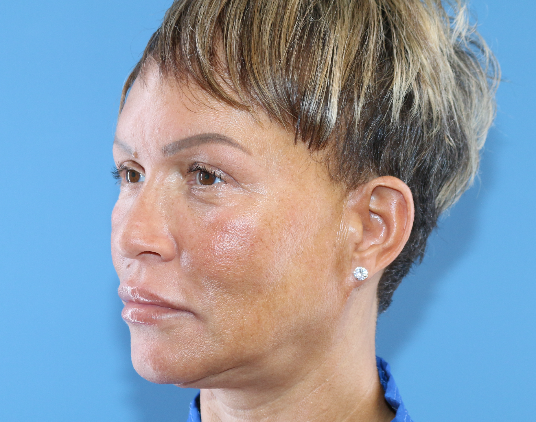 Blepharoplasty Before & After Gallery - Patient 229293 - Image 4