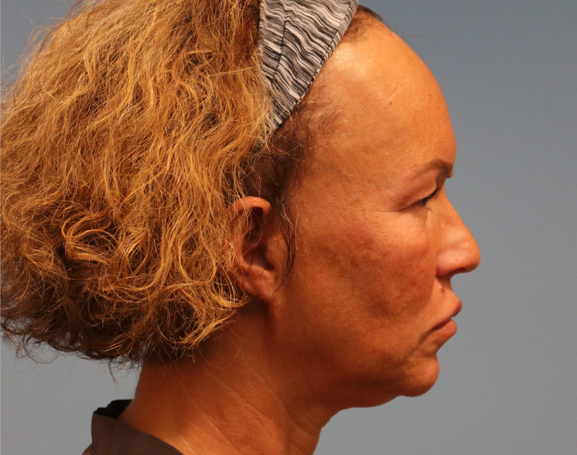 Blepharoplasty Before & After Gallery - Patient 229293 - Image 7