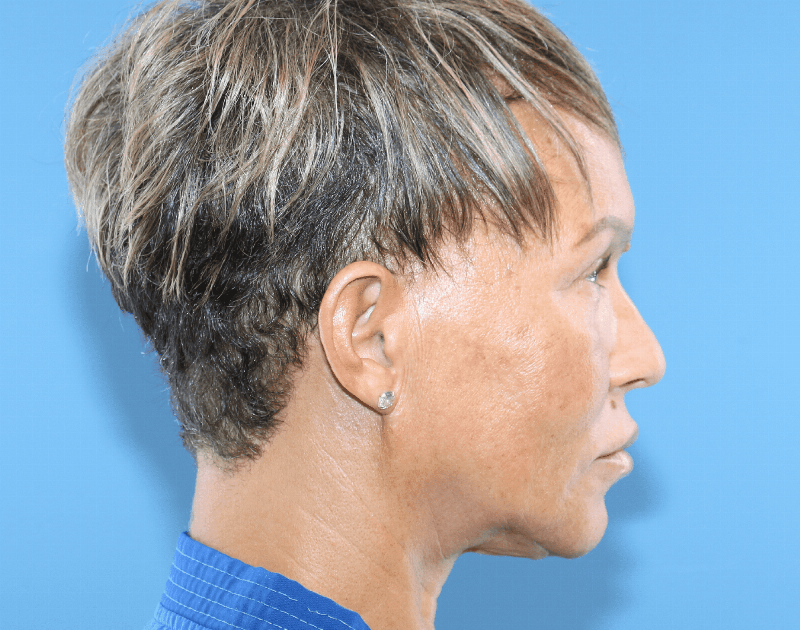 Blepharoplasty Before & After Gallery - Patient 229293 - Image 8