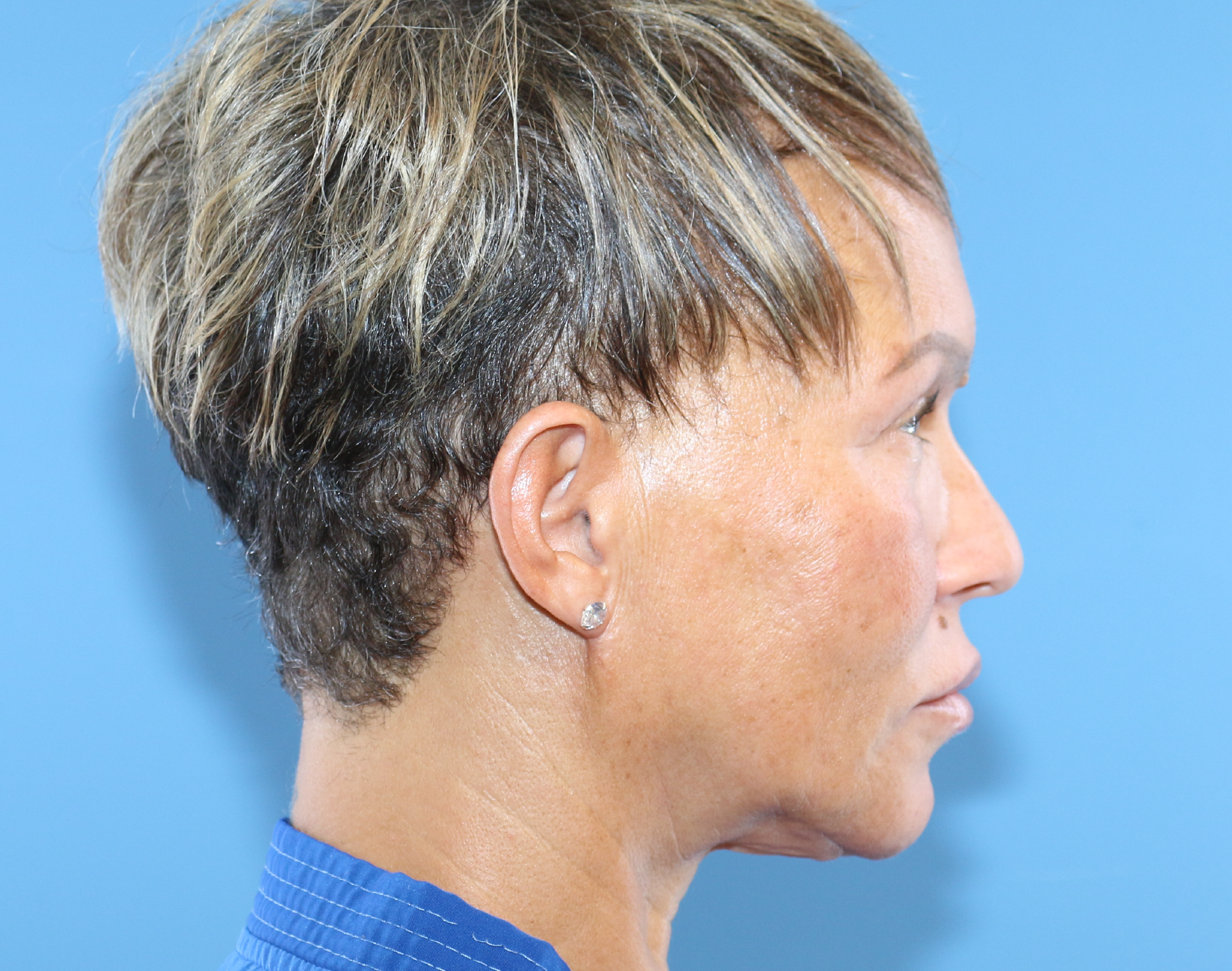 Blepharoplasty Before & After Gallery - Patient 229293 - Image 8