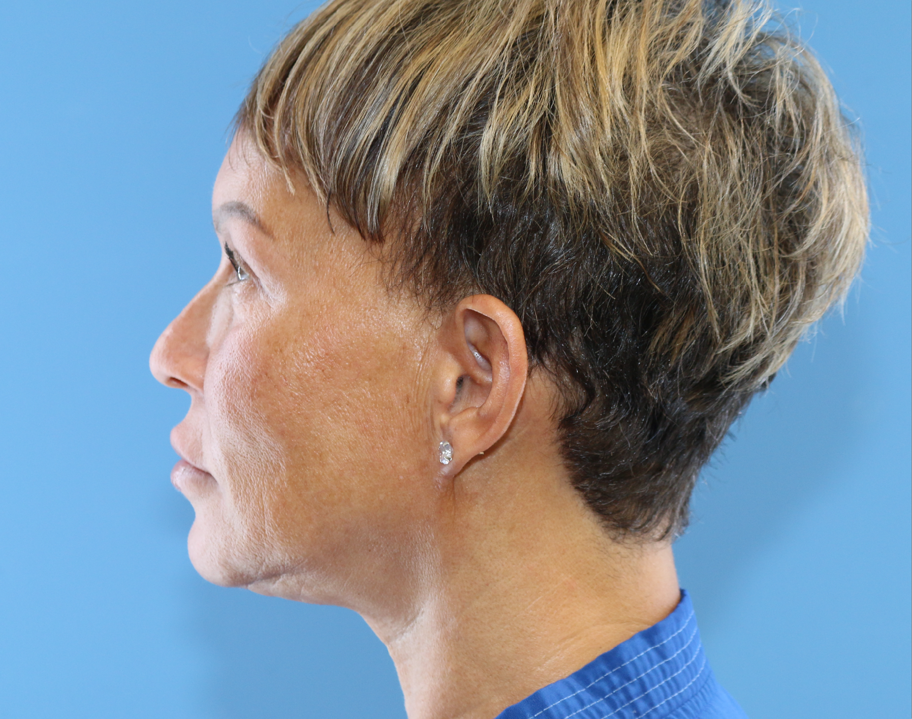 Blepharoplasty Before & After Gallery - Patient 229293 - Image 10