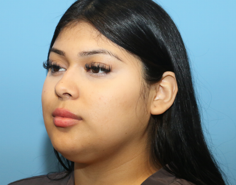 Buccal Fat Reduction Before & After Gallery - Patient 362415 - Image 3