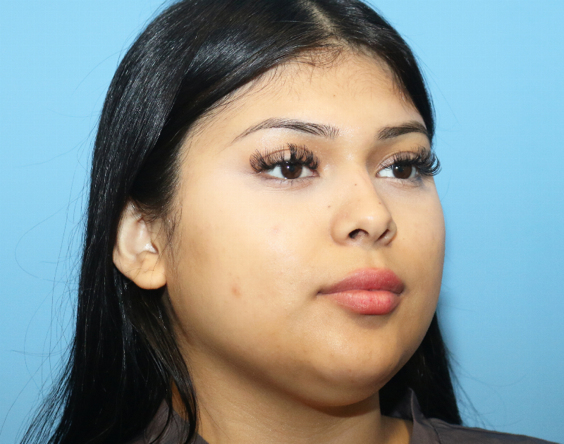 Buccal Fat Reduction Before & After Gallery - Patient 362415 - Image 5