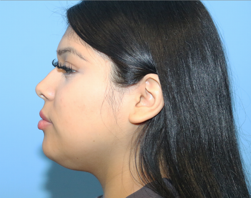 Buccal Fat Reduction Before & After Gallery - Patient 362415 - Image 7