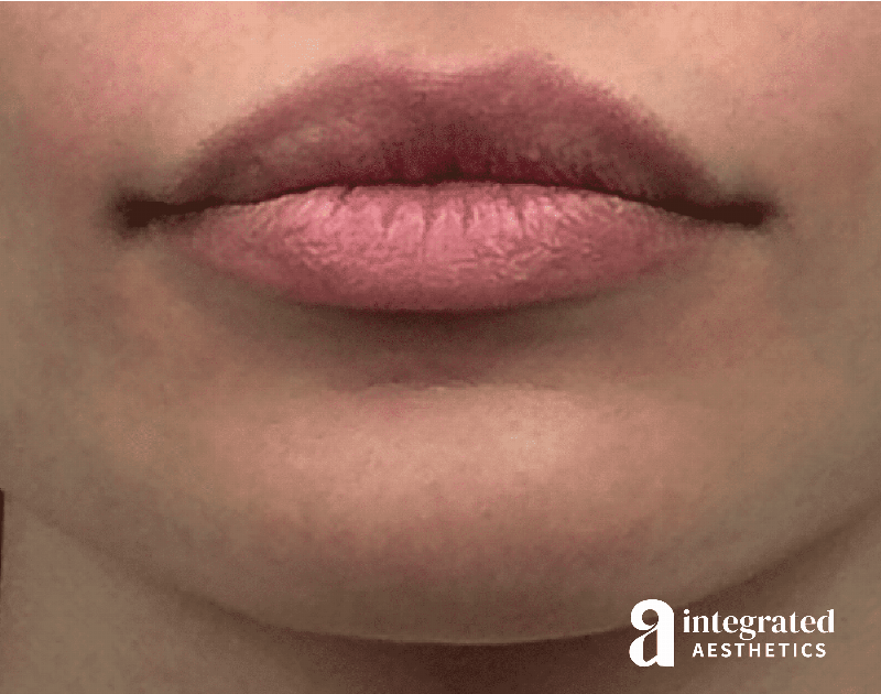 Lip Lift Before & After Gallery - Patient 175677 - Image 1