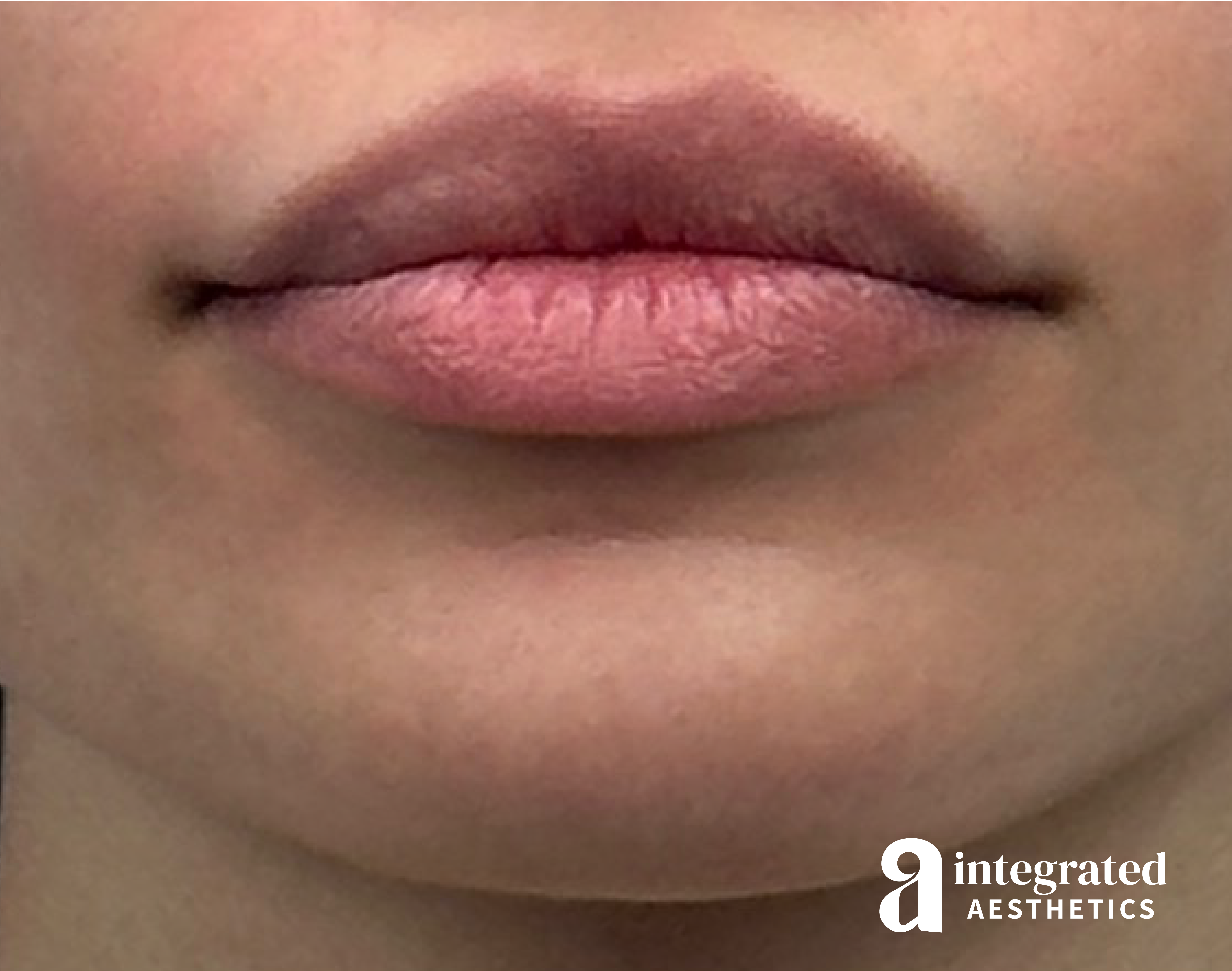 Lip Lift Before & After Gallery - Patient 175677 - Image 1