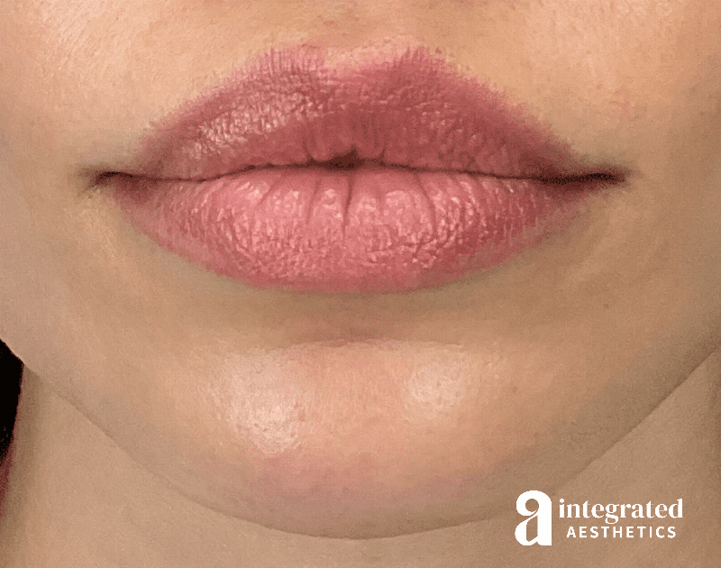 Lip Lift Before & After Gallery - Patient 175677 - Image 2