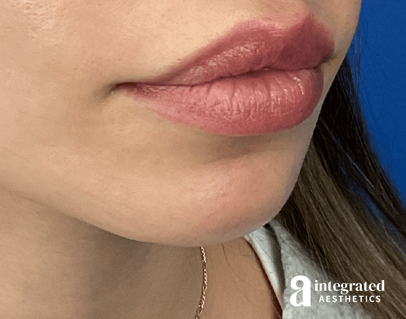 Lip Lift Before & After Gallery - Patient 175677 - Image 4